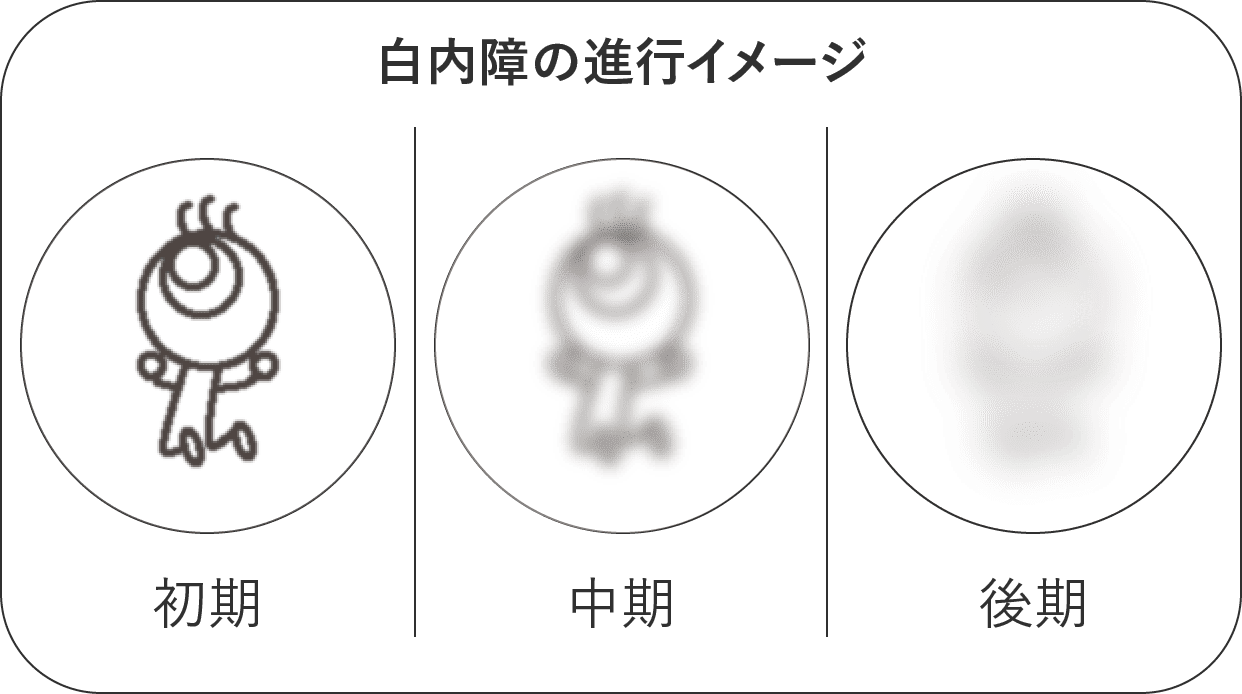 白内障の進行イメージ