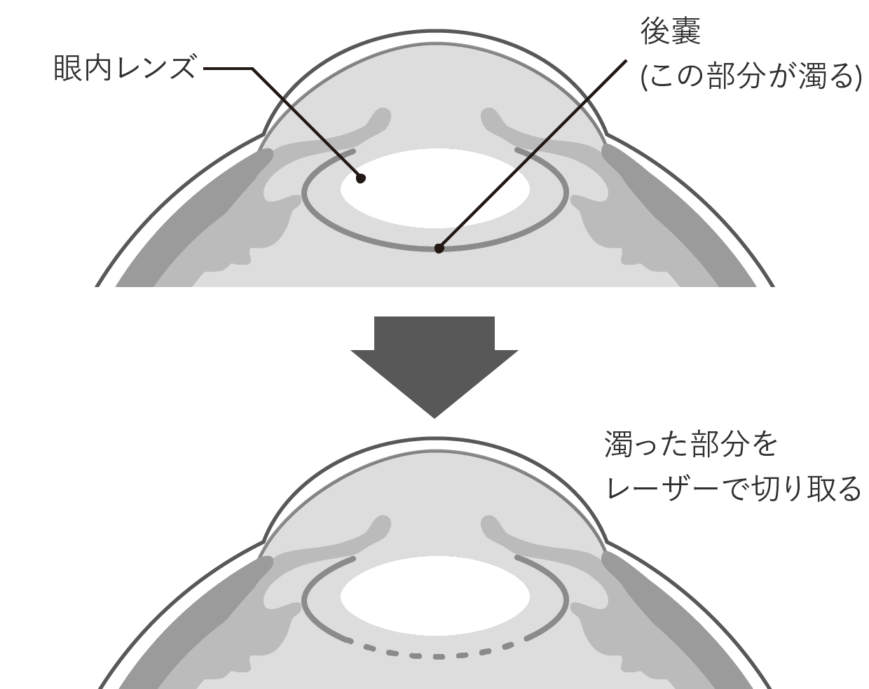 濁った部分をレーザーで切り取る