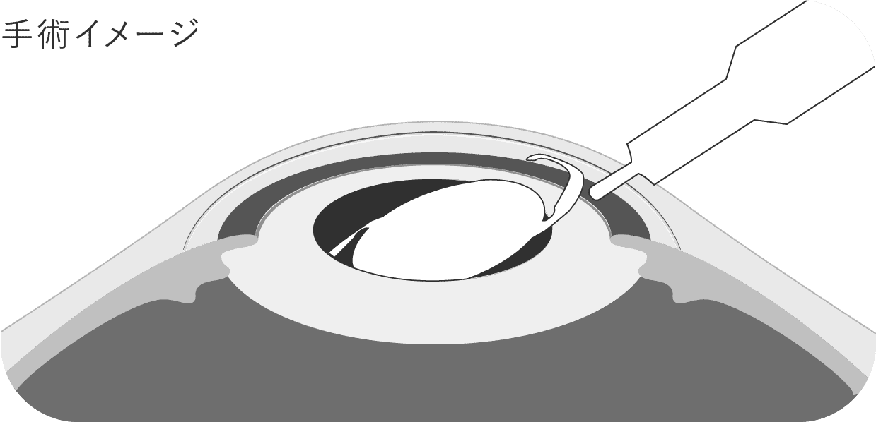 手術イメージ