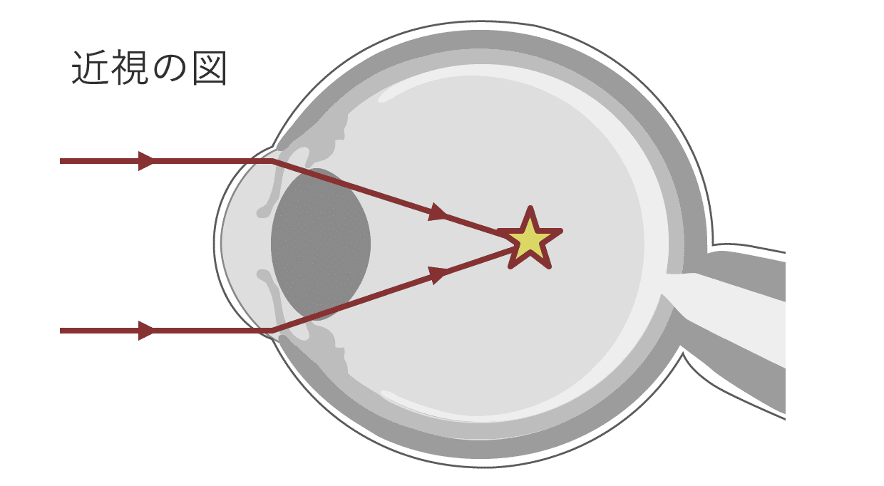 近視の図