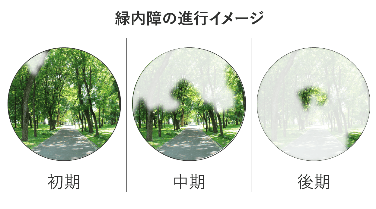 緑内障の進行イメージ