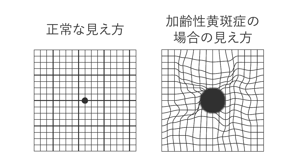 正常な見え方 加齢性黄斑症の場合の見え方