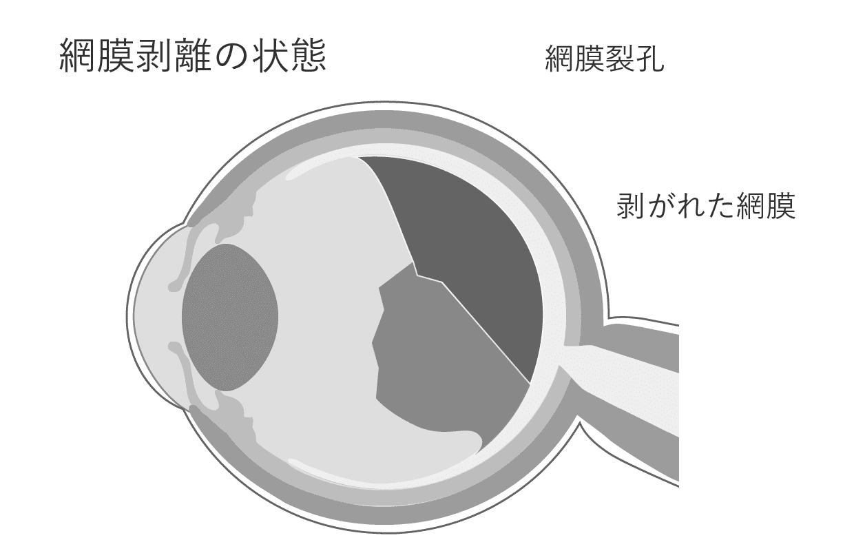 正常な見え方 加齢性黄斑症の場合の見え方