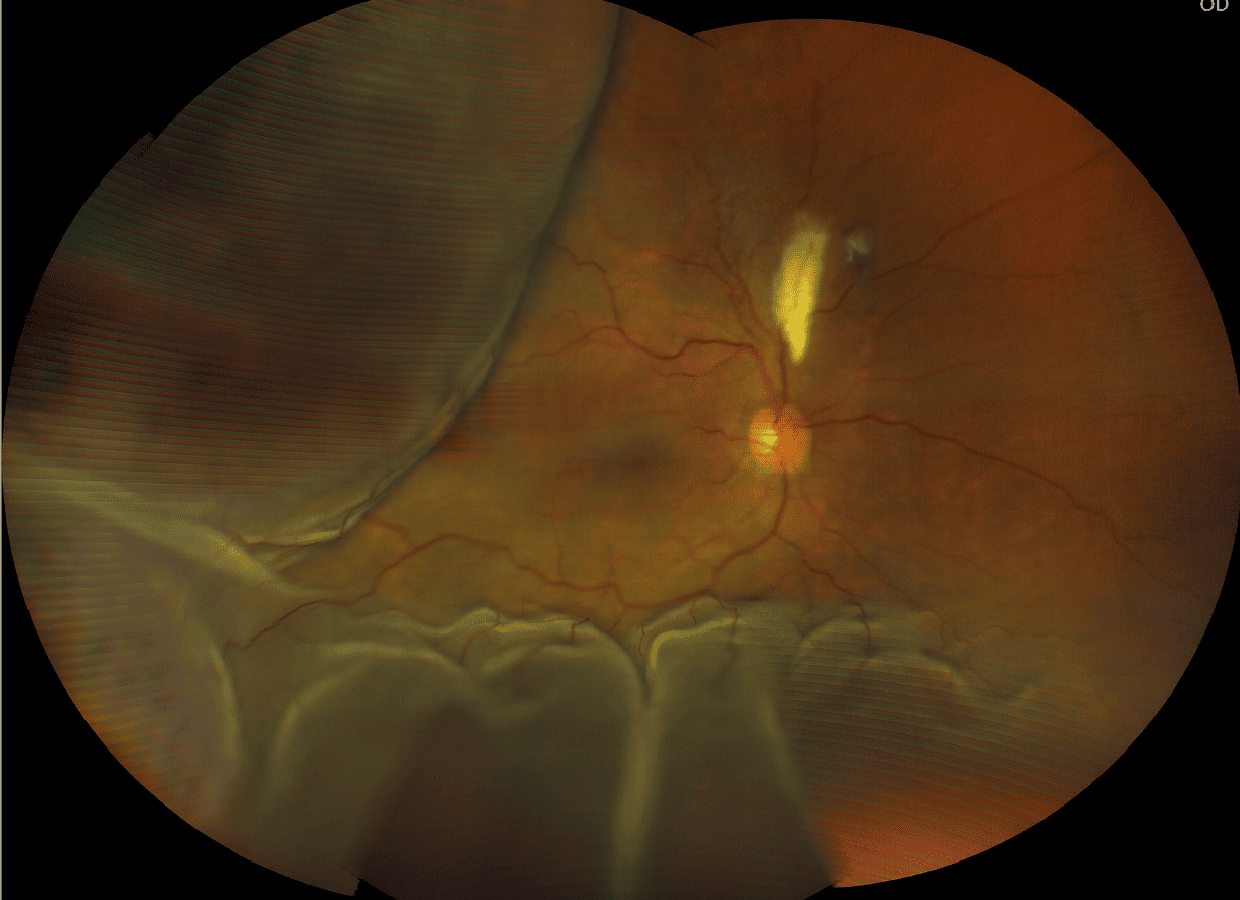 正常な見え方 加齢性黄斑症の場合の見え方