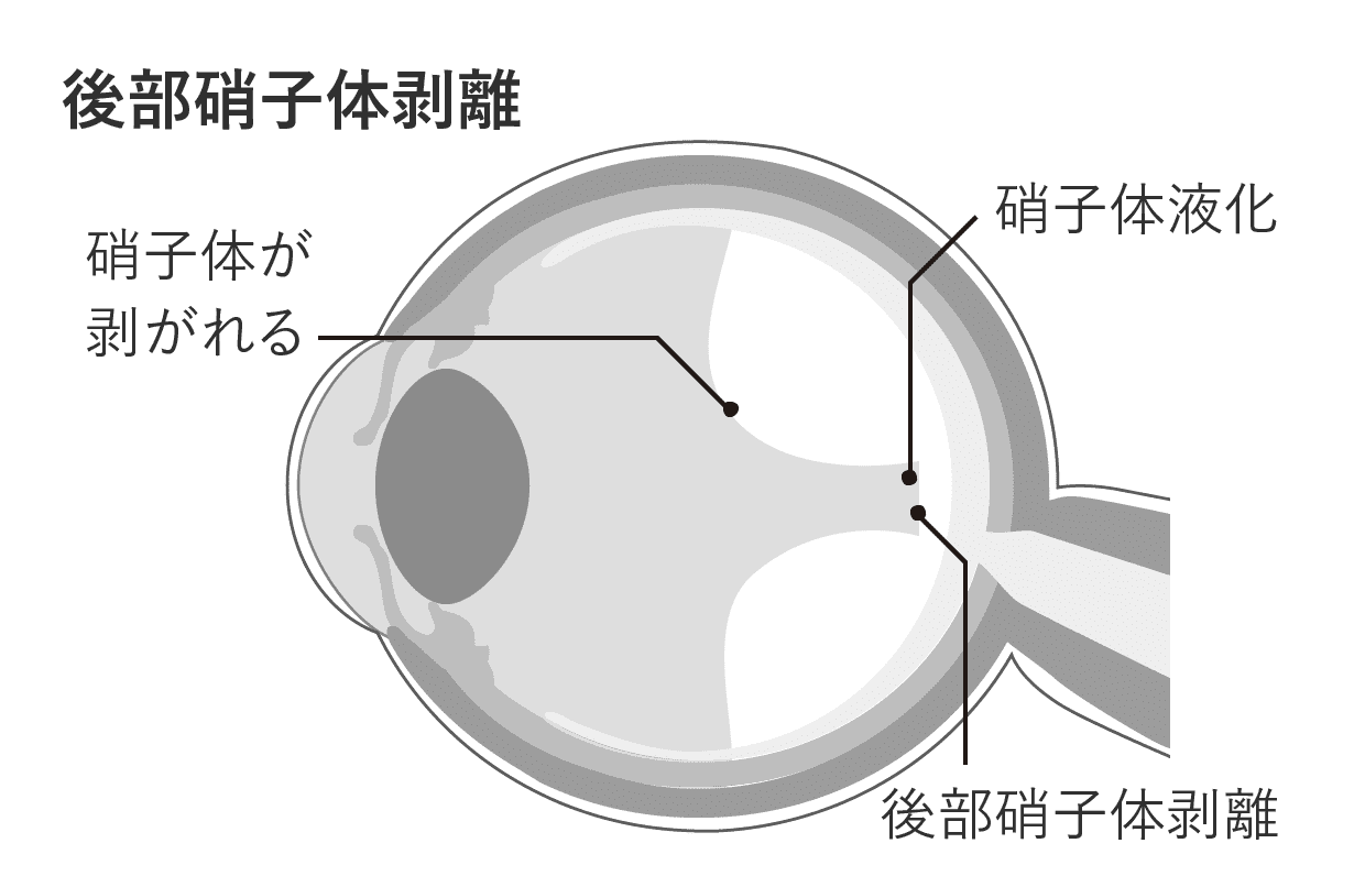 後部硝子体剥離