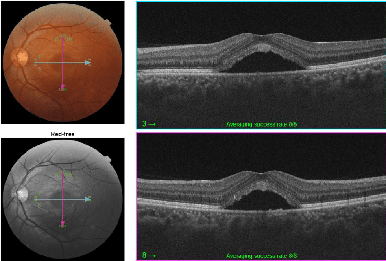 中心性漿液性脈絡網膜症