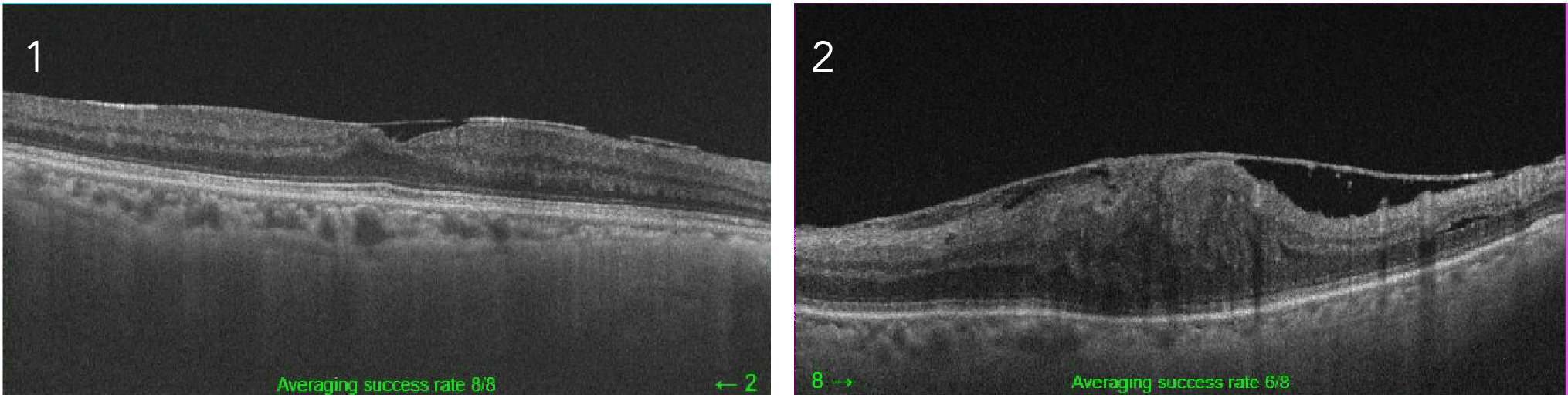 網膜上膜 (黄斑前膜)