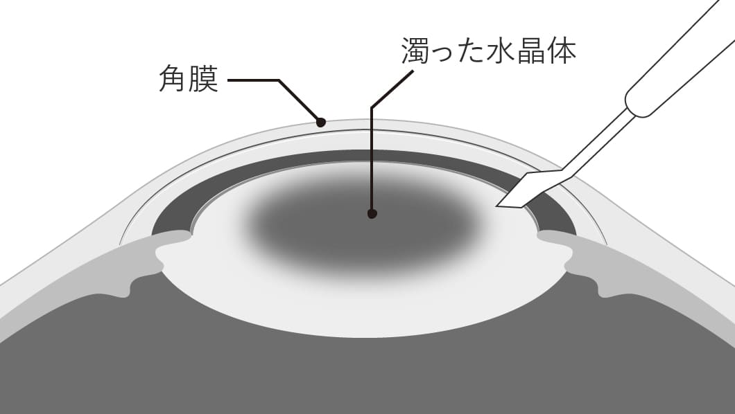 角膜 濁った水晶体
