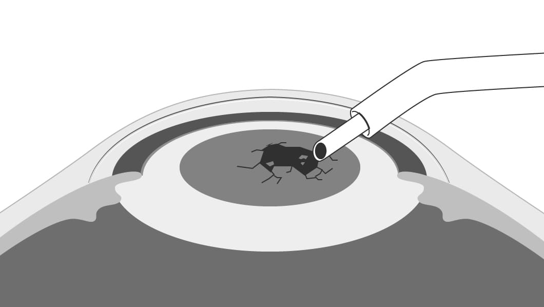 濁った水晶体を砕いて吸い出します。