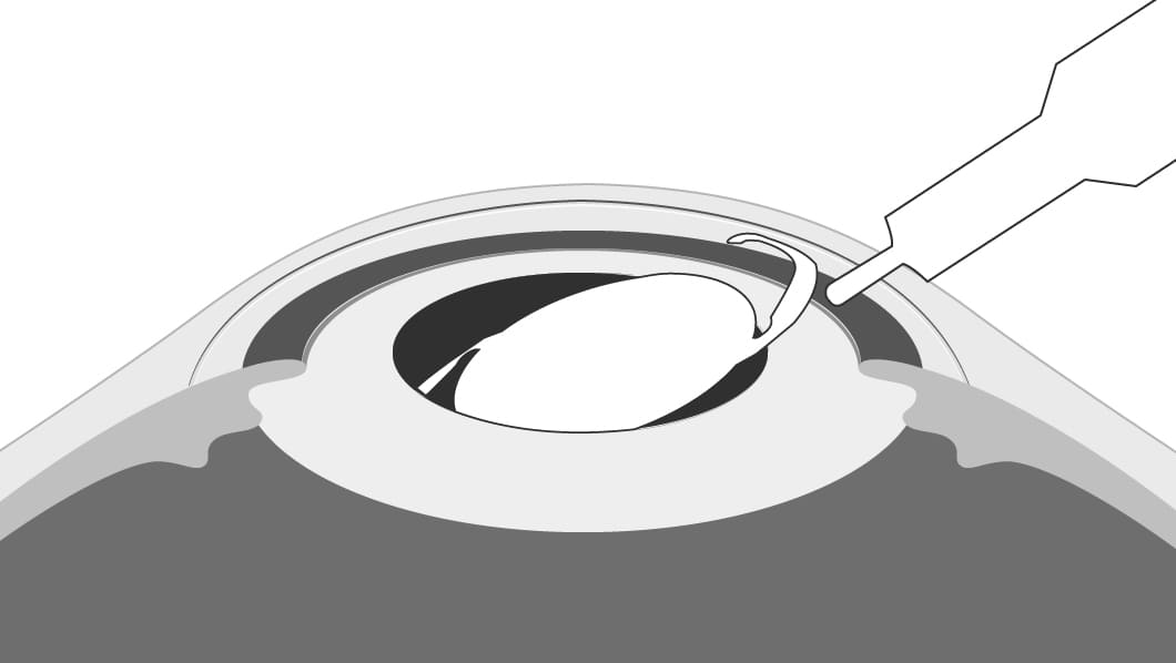 眼内レンズを挿入します。